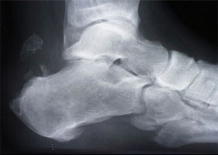Achilles Tendinosis - X-ray - Victorian Orthopaedic Foot & Ankle Clinic