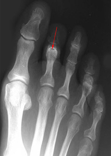 Pre Operative - Bent Knuckle Joint - X-ray - Victorian Orthopaedic Foot & Ankle Clinic