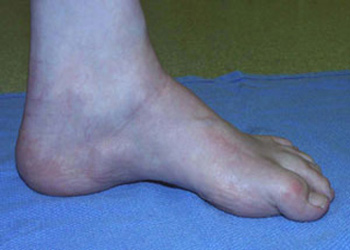 Post Operative - Charcot Marie Tooth - Victorian Orthopaedic Foot & Ankle Clinic