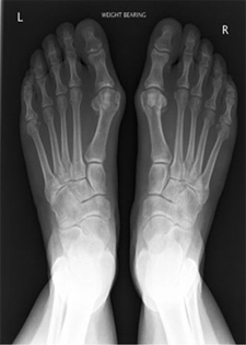 Hallux Valgus Deformities - X-ray - Victorian Orthopaedic Foot & Ankle Clinic