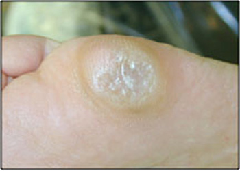 foot conditions in adults