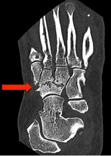 Midfoot Arthritis - CT Scan - Victorian Orthopaedic Foot & Ankle Clinic