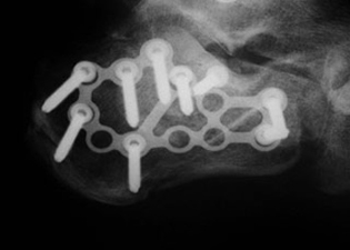 Posterior Calcaneal Spur