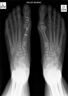 Post Operative - Hallux Valgus Deformities - X-ray - Victorian Orthopaedic Foot & Ankle Clinic