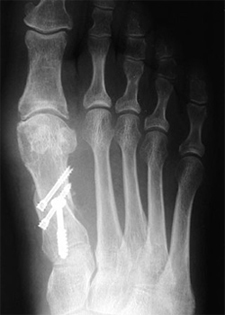 Post Operative - Hallux Valgus - X-ray - Victorian Orthopaedic Foot & Ankle Clinic