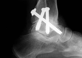 Post Operative -  Osteoarthritis - X-ray - Victorian Orthopaedic Foot & Ankle Clinic