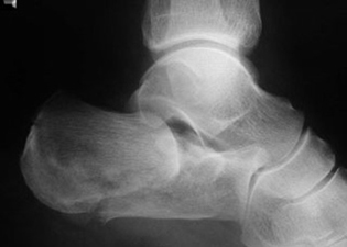 Inferior Calcaneal Spur