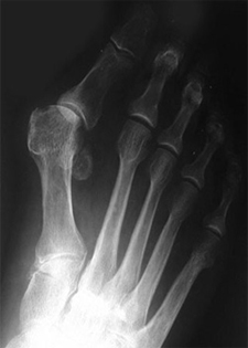 Pre Operative - Hallux Valgus - X-ray - Victorian Orthopaedic Foot & Ankle Clinic