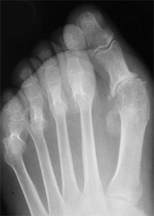 Pre Operative - Rheumatoid Arthritis - X-ray - Victorian Orthopaedic Foot & Ankle Clinic