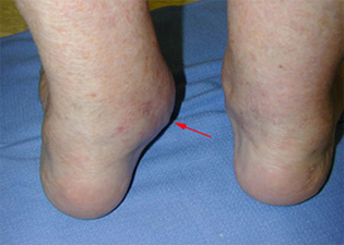 Pre Operative - Flatfoot Deformity - Victorian Orthopaedic Foot & Ankle Clinic