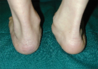 Pre Operative - Tibialis Posterior Tendon Disfunction  - Victorian Orthopaedic Foot & Ankle Clinic