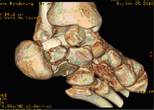 Pre Operative - Calcaneal Fracture - CT Scan - Victorian Orthopaedic Foot & Ankle Clinic