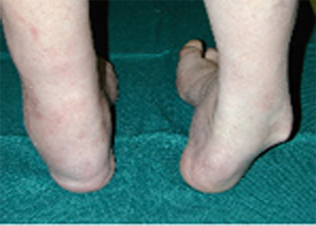Cavo Varus Deformity - Victorian Orthopaedic Foot & Ankle Clinic