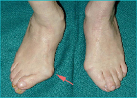 Hallux Valgus - Victorian Orthopaedic Foot & Ankle Clinic