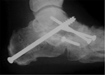 Post Operative - Calcaneocuboid & Talonavicular Joints - Victorian Orthopaedic Foot & Ankle Clinic