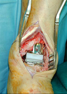 Intra Operative - Hintegra Total Ankle Replacement - Victorian Orthopaedic Foot & Ankle Clinic