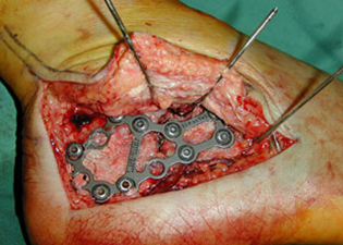 Intra Operative - Fractured Calcaneus - Heel Bone - Victorian Orthopaedic Foot & Ankle Clinic