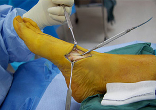 Intra Operative - Tibialis Anterior Tendon - Victorian Orthopaedic Foot & Ankle Clinic