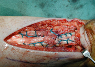 Intra Post Operative - Achilles Tendinosis - Victorian Orthopaedic Foot & Ankle Clinic