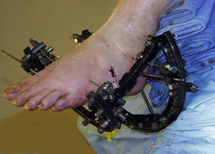 Intra Operative - Neuroarthropathy - Victorian Orthopaedic Foot & Ankle Clinic
