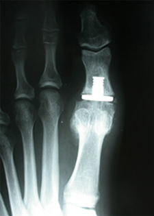 Joint Replacement - X-ray - Victorian Orthopaedic Foot & Ankle Clinic