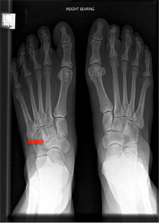 Midfoot Arthritis - X-ray - Victorian Orthopaedic Foot & Ankle Clinic