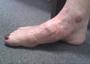 Midfoot Arthritis - Victorian Orthopaedic Foot & Ankle Clinic