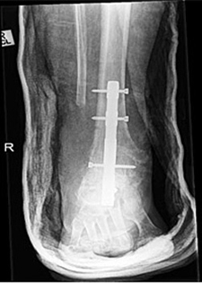 Post Operative - Hindfoot Deformities & Arthritis - X-ray - Victorian Orthopaedic Foot & Ankle Clinic