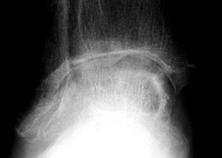 Pre Operative -  Osteoarthritis - X-ray - Victorian Orthopaedic Foot & Ankle Clinic