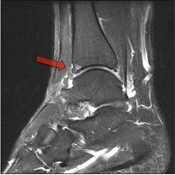 Osteochondral Defect - MRI - Victorian Orthopaedic Foot & Ankle Clinic