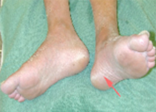 Plantar Fasciitis - Victorian Orthopaedic Foot & Ankle Clinic