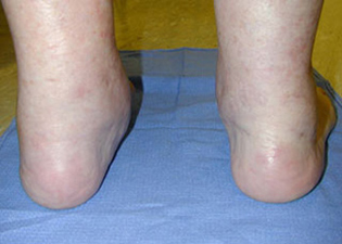 Post Operative - Flatfoot Deformity - Victorian Orthopaedic Foot & Ankle Clinic