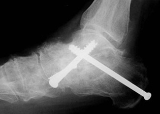 Post Operative - Triple Arthrodesis - X-ray - Victorian Orthopaedic Foot & Ankle Clinic