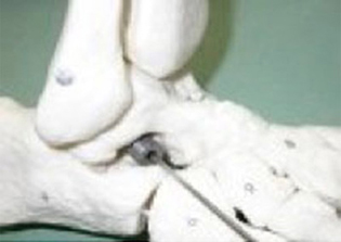 Post Operative - Arthroereisis Plug - Model - Victorian Orthopaedic Foot & Ankle Clinic