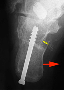 Post Operative - Osteotomy - X-ray - Victorian Orthopaedic Foot & Ankle Clinic