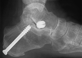 Post Operative - Osteotomy - X-ray - Victorian Orthopaedic Foot & Ankle Clinic
