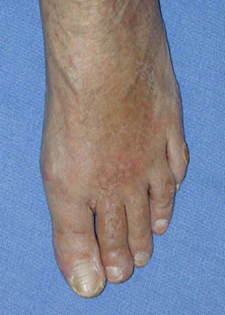 Post Operative - Bent Knuckle Joint - Victorian Orthopaedic Foot & Ankle Clinic