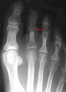 Post Operative - Bent Knuckle Joint - X-ray - Victorian Orthopaedic Foot & Ankle Clinic