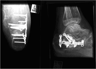 Post Operative - Calcaneal Fracture - Internal Fixation - X-ray - Victorian Orthopaedic Foot & Ankle Clinic