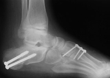 Post Operative - Charcot Marie Tooth - X-ray - Victorian Orthopaedic Foot & Ankle Clinic