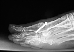 Post Operative - Arthrodesis - X-ray - Victorian Orthopaedic Foot & Ankle Clinic