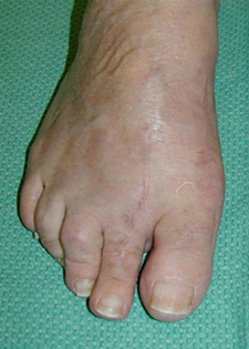Post Operative - Hallux Valgus - Victorian Orthopaedic Foot & Ankle Clinic