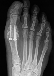 Post Operative - Arthrodesis - X-ray - Victorian Orthopaedic Foot & Ankle Clinic
