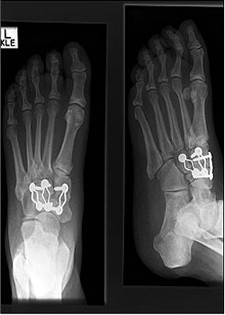 Post Operative - Midfoot Arthritis - X-ray - Victorian Orthopaedic Foot & Ankle Clinic
