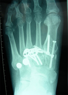 Post Operative - Midfoot Arthritis - X-ray - Victorian Orthopaedic Foot & Ankle Clinic