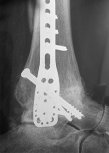 Post Operative - Osteoarthritis - X-ray - Victorian Orthopaedic Foot & Ankle Clinic