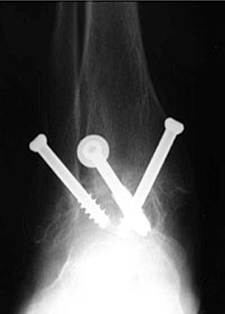 Post Operative - Osteoarthritis - X-ray - Victorian Orthopaedic Foot & Ankle Clinic