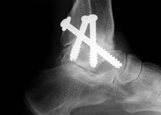 Post Operative - Osteoarthritis - X-ray - Victorian Orthopaedic Foot & Ankle Clinic