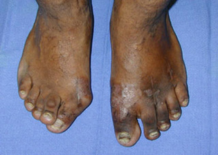 Post Operative - Rheumatoid Arthritis - Victorian Orthopaedic Foot & Ankle Clinic