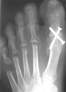 Post Operative - Rheumatoid Arthritis - X-ray - Victorian Orthopaedic Foot & Ankle Clinic